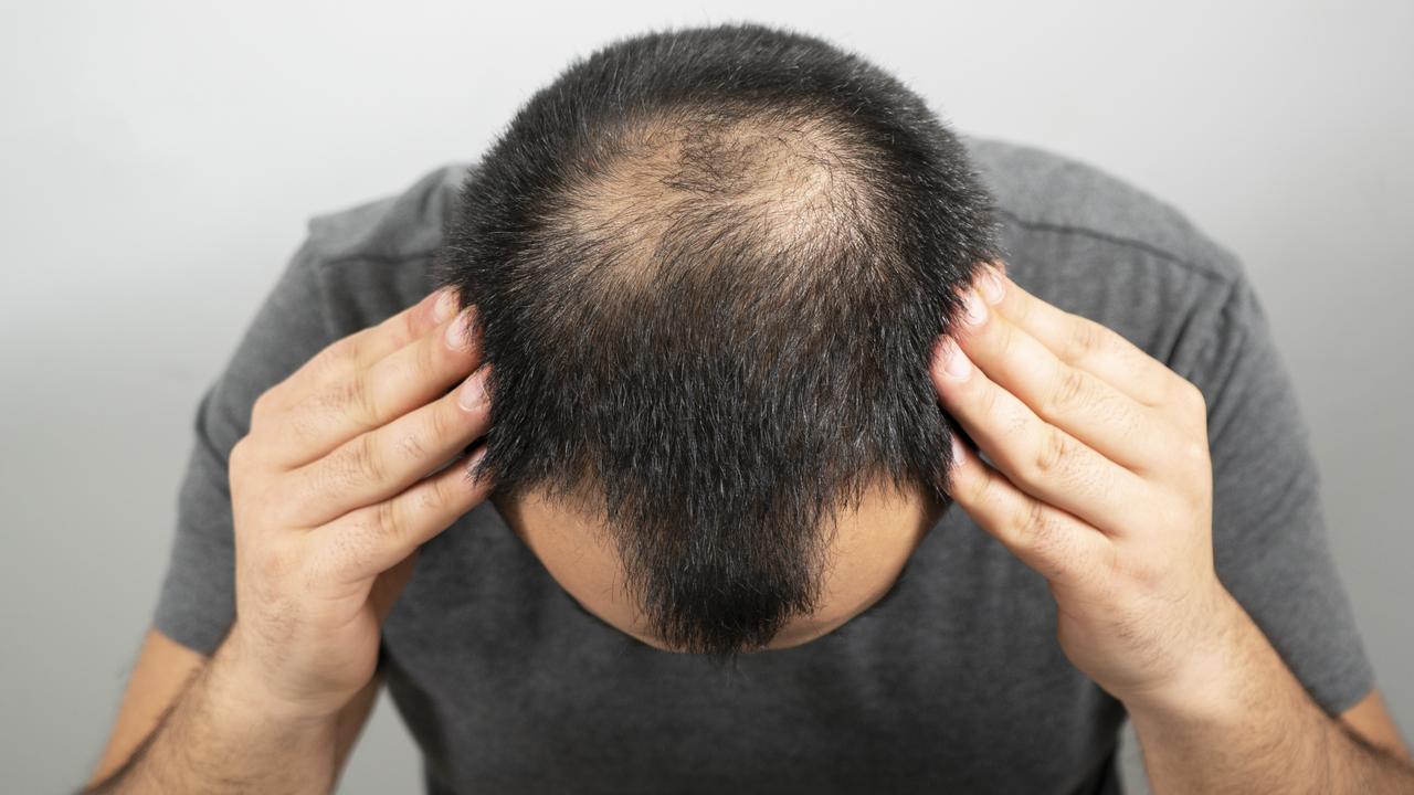 Why are so many young men losing their hair?