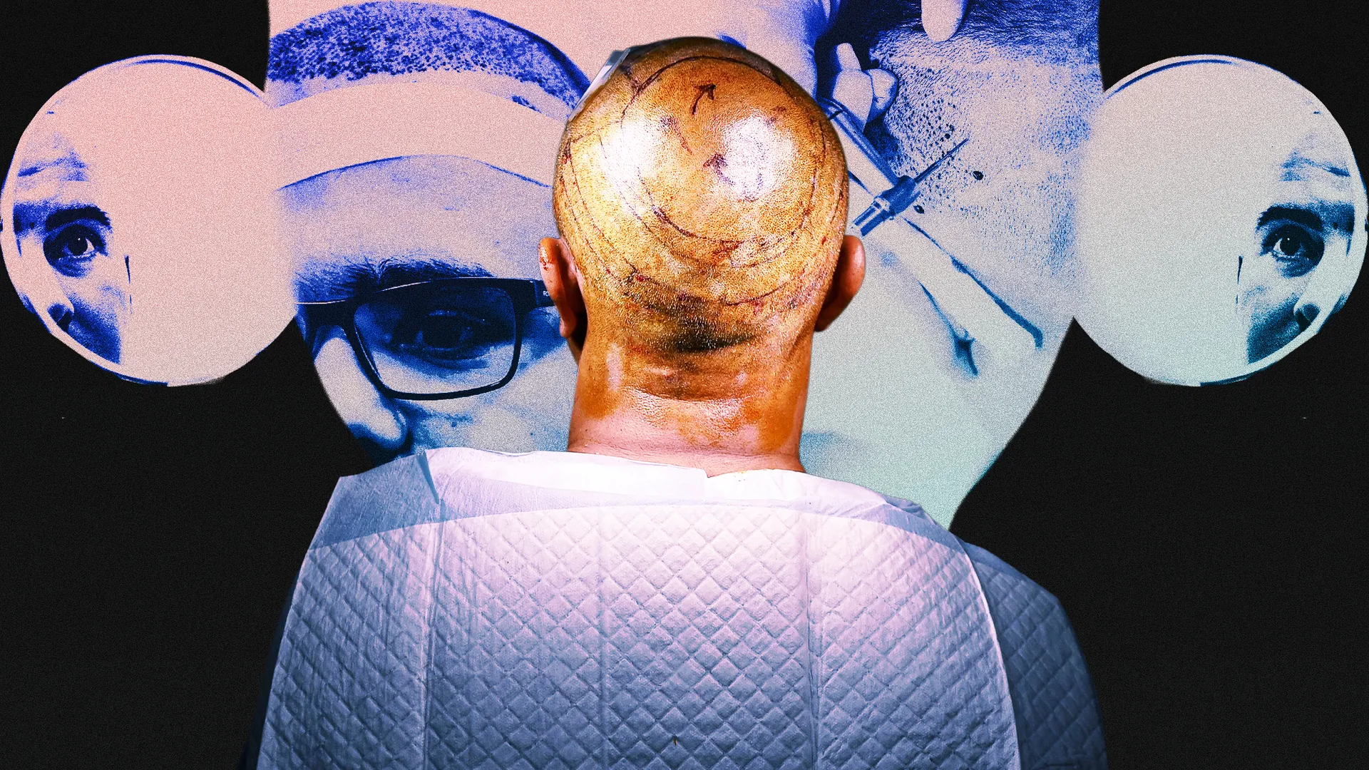I got a cheap hair transplant in Turkey, the recovery was agony, and I'd do it again in a heartbeat