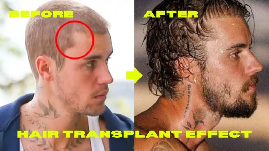 Justin Bieber Hair Transplant: Justin's Hairline Overview