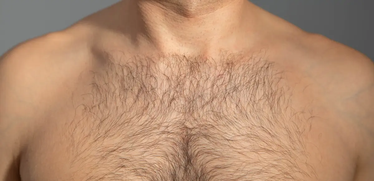 Göğüs Kıllarından Saç Ekimi 1 Göğüs Kıllarından Saç Ekimi