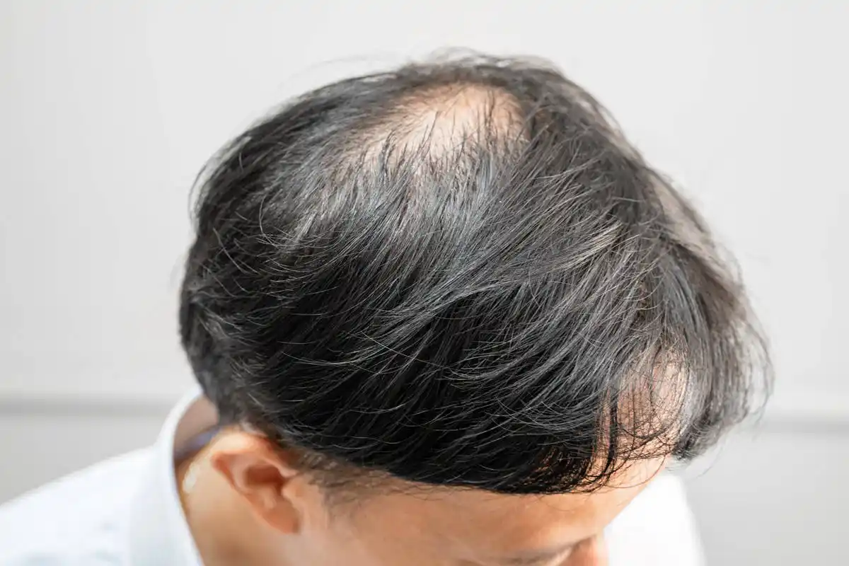 Minoxidil yan etkileri