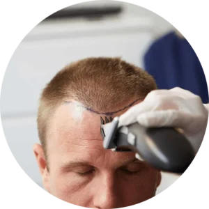 tıraşsız saç ekimi