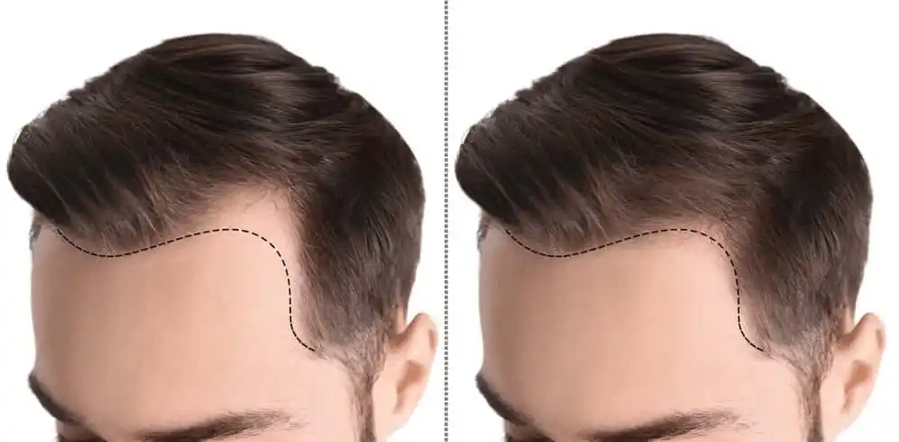 Tıraşsız saç ekimi