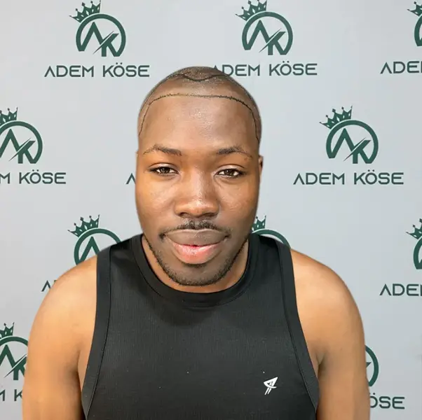 afro hair transplant in istanbul