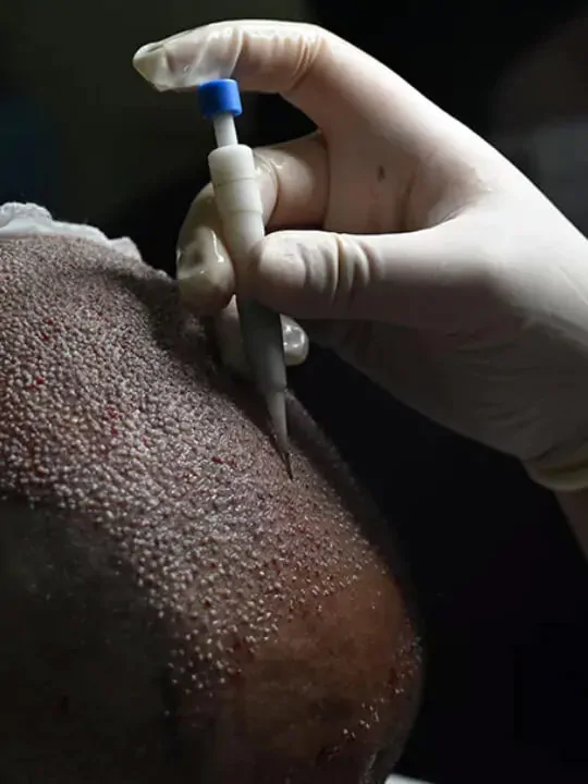 DHI Hair Transplant in Turkey, Istanbul