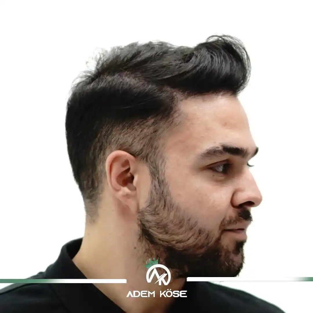 saç ekimi sonucu Saç ekimi sonucu