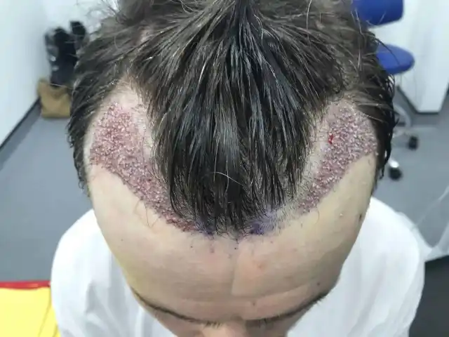 Saç kestirmeden saç ekimi