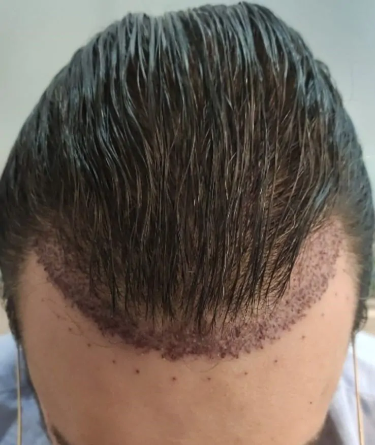 saç kestirmeden saç ekimi