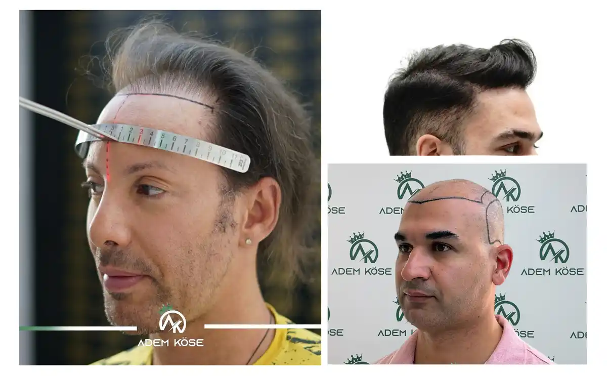 Hair Transplant Turkey