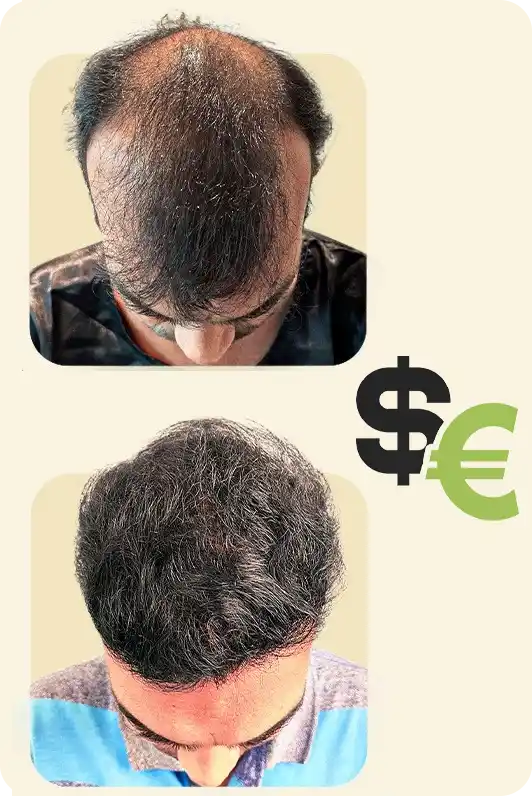 Hair transplant cost