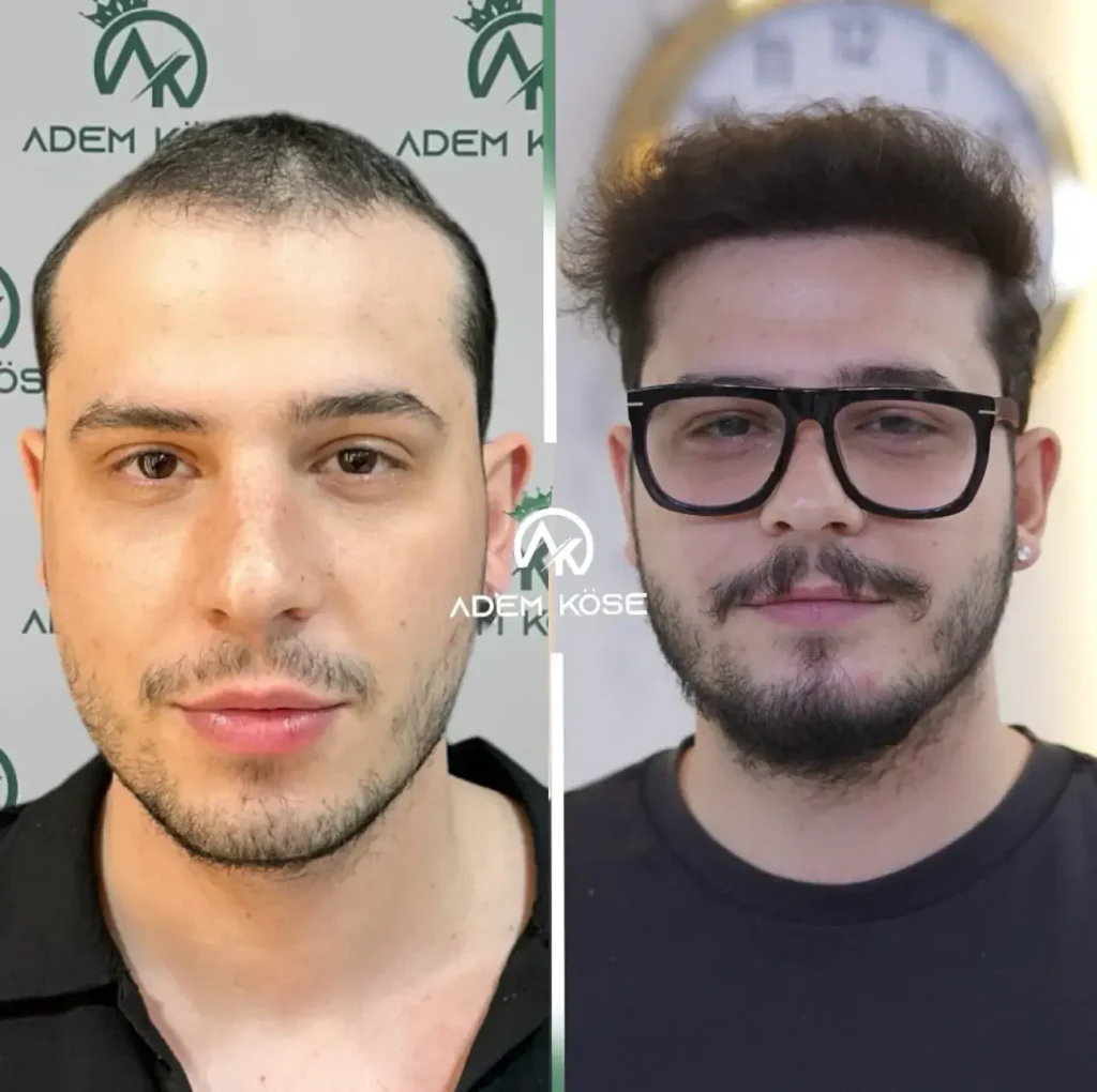 hair transplant turkey cost