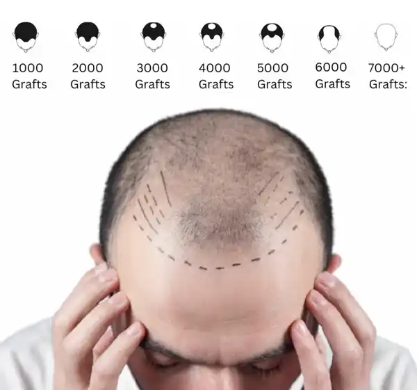 Hair transplant turkey cost by grafts