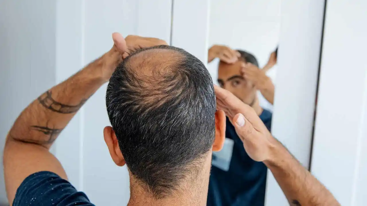 Saç Ekimi Hakkında Sık Sorulan 10 Soru