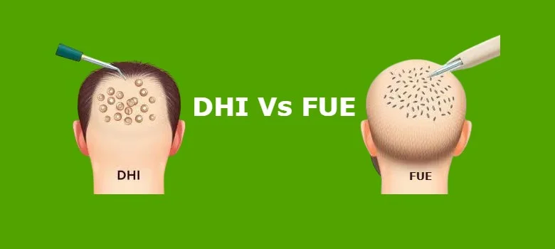 FUE Mi DHI Mı?